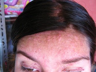 Eliah Pizarro
                Carbajal, su frente con exantema sin fin