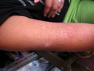 Eliah Pizarro Carbajal, brazo con manchas