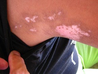 Eliah Pizarro Carbajal, mancha grande cerca
                        del axila