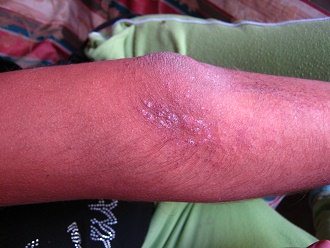 Eliah Pizarro Carbajal, pierna