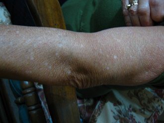 Mar�a Cristina con manchas rozadas en su
                          brazo