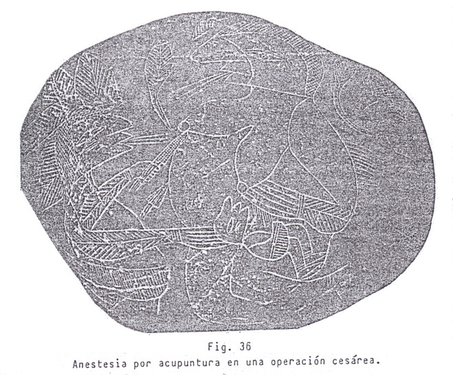 Fig.
                                36: Anestesia con acupuntura en una
                                operaci�n de ces�rea