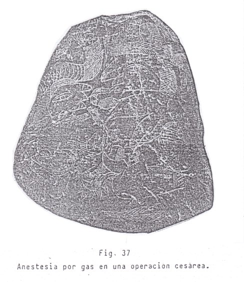 Fig. 37: Anestesia
                                de gas en una operaci�n de ces�rea