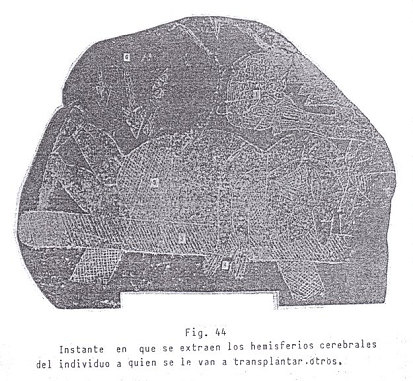 Fig. 44: Extracci�n de un cerebro
