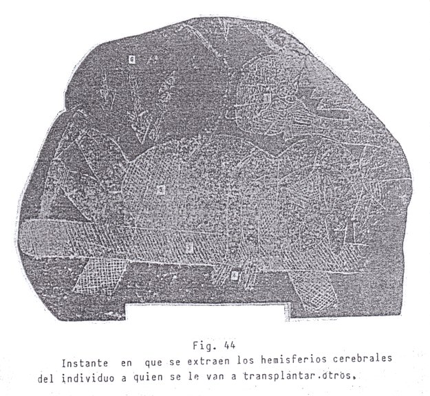 Fig. 44: Extracci�n
                                de un cerebro