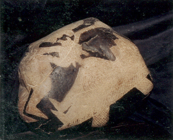 Heart surgery
                            with a man 03