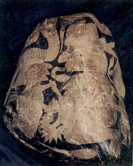 Cesarean with twins 02