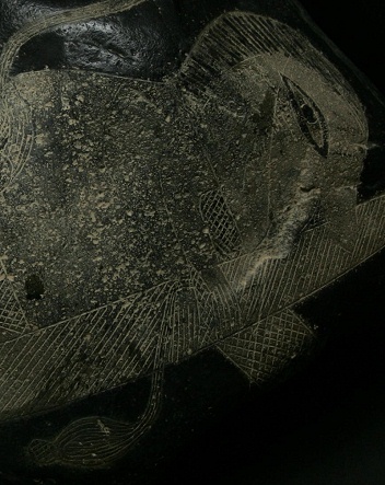 Kidney surgery, the patient with an
                            infusion