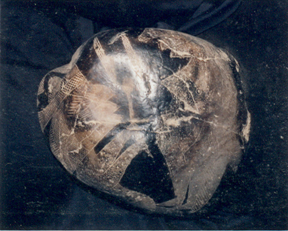 Nipple surgery
                          (this is the indication on the CD of the
                          museum)