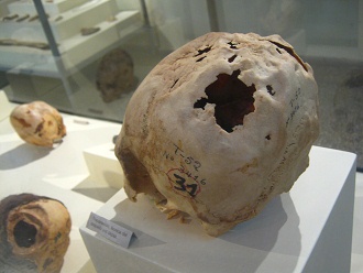 Aufgebohrter Sch�del 02,
                                  Nahaufnahme