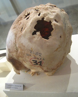 Aufgebohrter Sch�del 02,
                                  Nahaufnahme 02