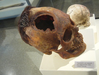 Aufgebohrter Sch�del 03