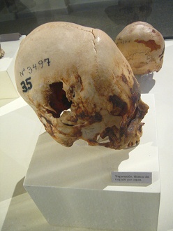 Aufgebohrter Sch�del 04