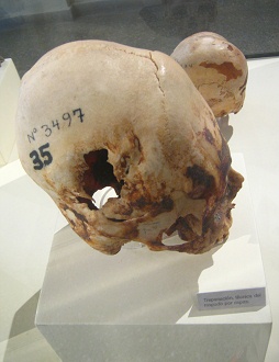 Aufgebohrter Sch�del 04, zweites
                                  Foto
