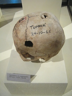 Aufgebohrter Sch�del 06