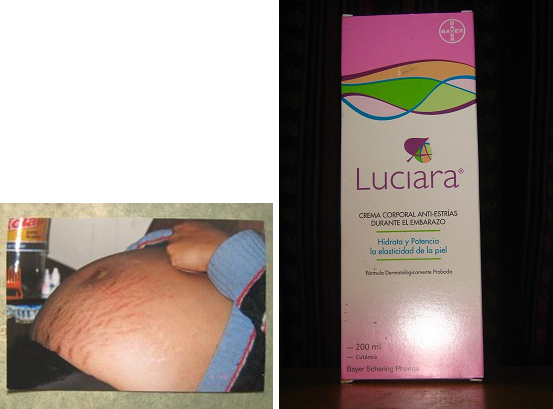 Una mujer embarazada con estrillas sin crema - y
              aqu� est� la crema Luciara con efecto contra estrillas.