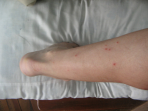 Fl�he, Frassbild der Flohbisse an der linken
                      Wade